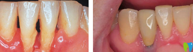 榆林長虹口德國種植牙系統(tǒng)案例