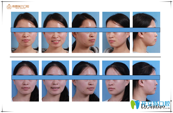 尖牙阻生，前突