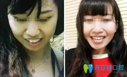 康美口腔牙齒矯正手術效果