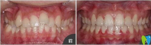 <!--<i data=20240703-sp></i>-->口腔張瓊牙齒矯正真人案例效果對比