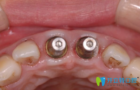 前牙種植有哪些種類？