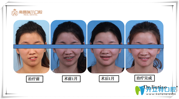 中線不齊伴前突真人案例