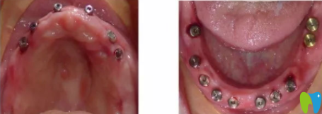60歲老人在宏沅膛口腔做滿(mǎn)口牙種植手術(shù)中