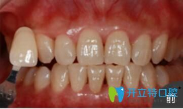 <!--<i data=20240703-sp></i>-->口腔美容冷光牙齒美白真人案例術(shù)前照