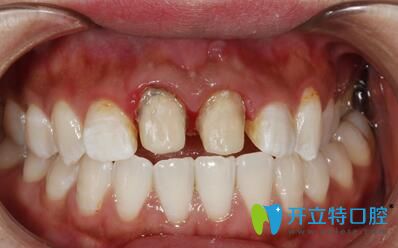 拆除原烤瓷牙重新補(bǔ)牙備牙 拆除原烤瓷牙重新補(bǔ)牙備牙