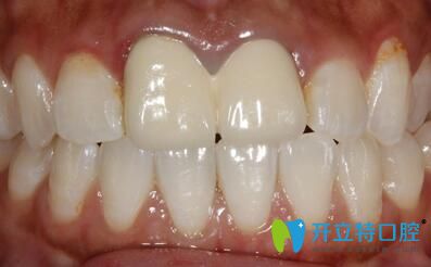原烤瓷牙唇側(cè)觀 原烤瓷牙唇側(cè)觀