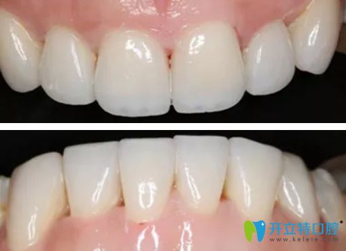 云浮拜爾口腔全瓷牙貼面效果 云浮拜爾口腔全瓷牙貼面效果