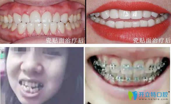愛德口腔瓷貼面+牙齒矯正效果