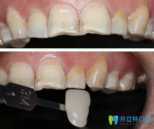 牙齒比色和全瓷牙貼面粘結(jié) 牙齒比色和全瓷牙貼面粘結(jié)