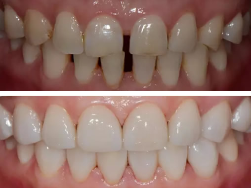 來通化愛德口腔做美加瓷貼面修復前 我牙齒暗黃牙列稀疏