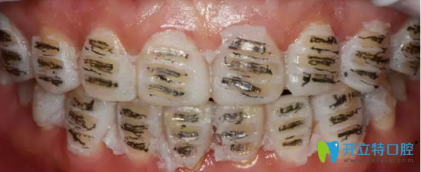 做瓷貼面前對牙齒進(jìn)行打磨