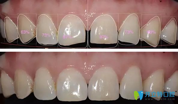 術(shù)前微笑設(shè)計和模擬瓷貼面修復(fù)效果