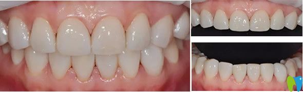 通化愛德口腔瓷貼面修復(fù)效果