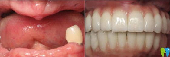 深圳同步齒科全口牙種植效果案例