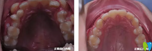兒童牙齒正畸案例：上牙正畸前后對(duì)比照
