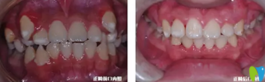 漢中小虎牙口腔兒童牙齒正畸前后對(duì)比圖