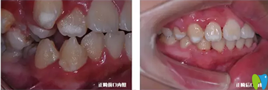 漢中小虎牙口腔兒童牙齒正畸案例：上牙虎牙出正畸前后對(duì)比圖