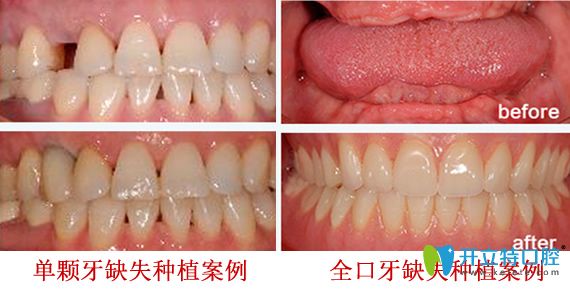 深圳拜博口腔好不好？深圳拜博口腔牙齒種植案例效果來證明實力