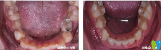 小虎牙口腔兒童牙齒正畸下牙正畸前后對(duì)比照