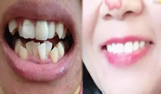 深圳拜博口腔一年半牙齒矯正結(jié)束啦，接下來開始戴保持器