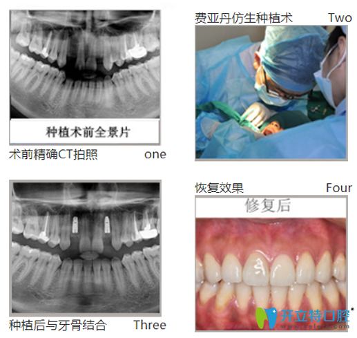 黎強給口牙缺失、牙槽骨萎縮幻陣采用德國費亞丹種植技術(shù)種牙過程圖