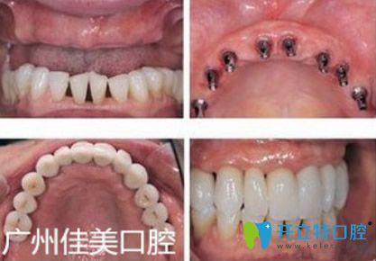 廣州佳美口腔半口牙缺失種植效果