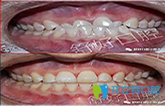 威海舒好口腔牙齒矯正案例對(duì)比圖