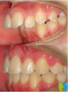 佳美口腔齙牙矯正真人案例