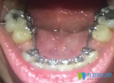 格倫菲爾（唐健）口腔牙齒正畸1年后效果圖