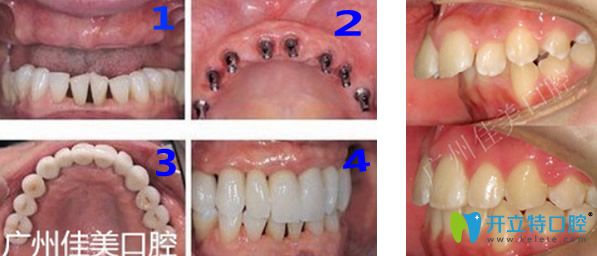 廣州佳美口腔牙齒種植+齙牙矯正效果對(duì)比圖