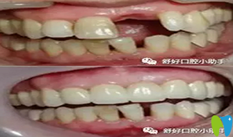 威海舒好口腔種植牙對(duì)比圖