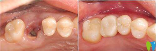 威海舒好口腔怎么樣？種植牙案例及前后對(duì)比效果圖展示