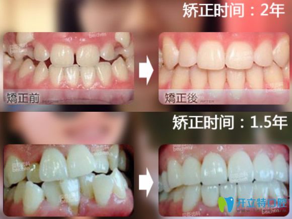 成都貝臣齒科價(jià)格表,種牙1800元起+矯正4999起,牛王廟地鐵站旁