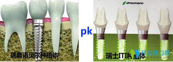 瑞典諾貝爾種植體和瑞士ITI種植體哪個(gè)好 種牙價(jià)格要多少錢