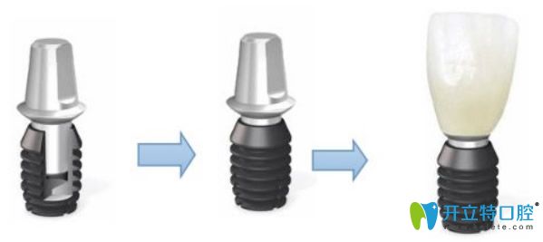 美國百康種植體的優(yōu)點(diǎn)有哪些及種植一顆牙的價(jià)格要多少錢
