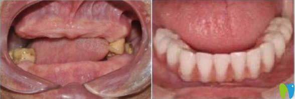 全口牙缺失怎么辦？合肥美奧口腔全口種植牙案例效果賞析