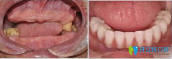 合肥美奧口腔全口種植牙案例及前后對(duì)比效果