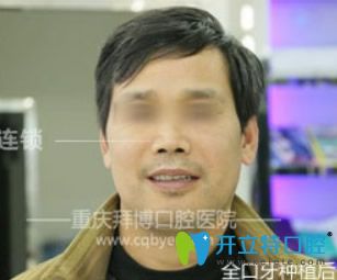 重慶拜博口腔即刻種植牙效果