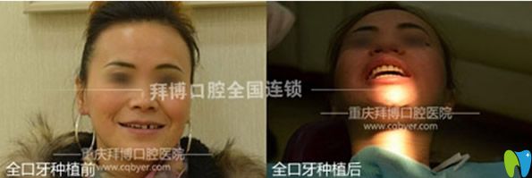 重慶拜博口腔全口牙種植效果案例