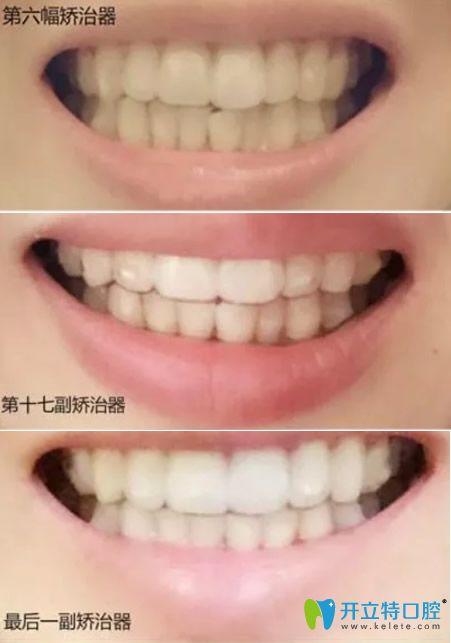 成都貝臣齒科牙齒矯正變化過(guò)程圖