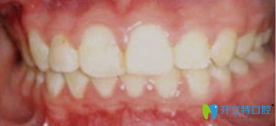 太平洋口腔牙齒矯正一年后的效果