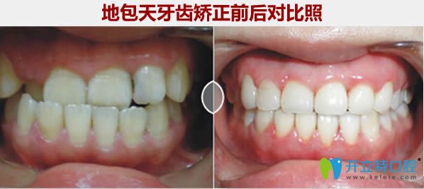 西安小白兔口腔地包天牙齒矯正對比照