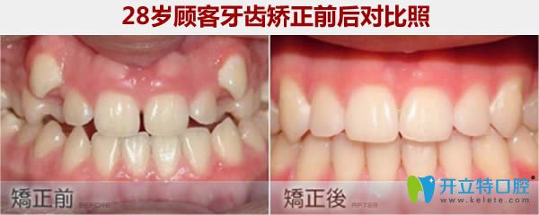 西安小白兔28歲牙齒矯正前后對比照