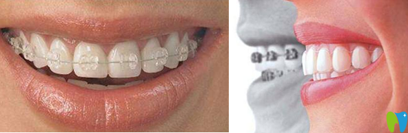 半隱形陶瓷托槽矯正和時代天使隱形矯正
