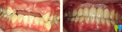 青島可恩口腔萬(wàn)金華種植牙前后效果對(duì)比圖