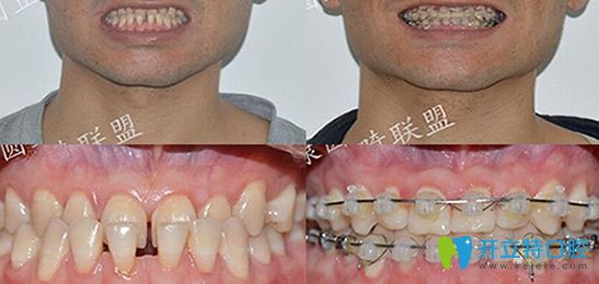 廣州康圓口腔牙齒正畸案例對比圖