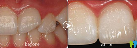 深圳愛(ài)康健齒科補(bǔ)牙治療前后對(duì)比圖