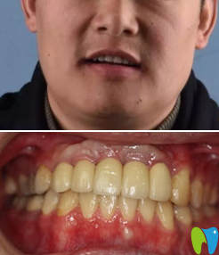 青島可恩口腔即刻種植牙術(shù)