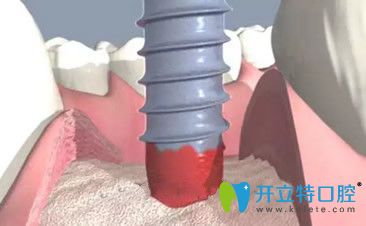 種植牙前要先植入種植體