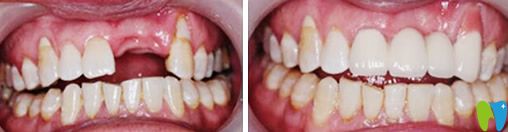 深圳瑞爾齒科種植牙效果